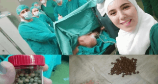 استخراج ١٨٠ حصاة من مثانة مريض خلال عمل جراحي في مشفى الاسد الجامعي بدمشق