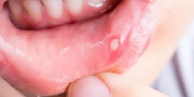 4 علامات في الفم تحذرك من نقص شديد في فيتامين ب 12.. لا تهملها وكالة