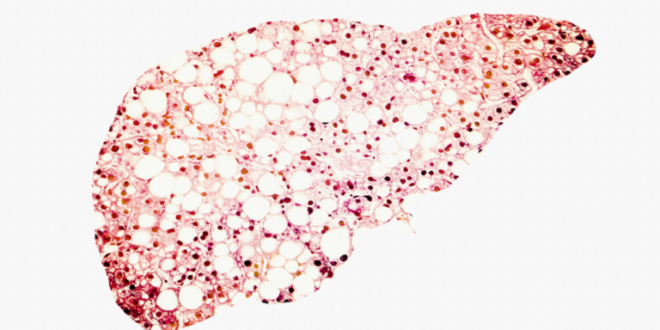 علامة تحذير في بطنك قد تدل على مرض الكبد الدهني!