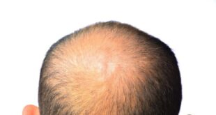 طبيب روسي يحدد العقارات المسببة لتساقط الشعر