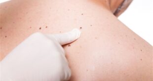 ما علامات تحول الشامات إلى سرطان الجلد