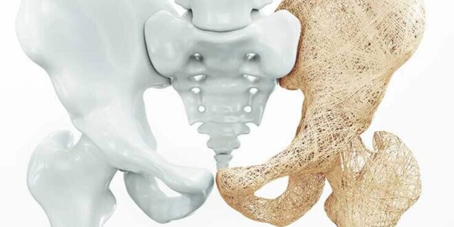 علامة وحيدة تشير للإصابة بهشاشة العظام
