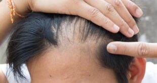 علاج الشعر الخفيف وطرق تكثيف الشعر