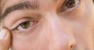 هل يشير عماص العين لمشكلة صحية خطيرة؟