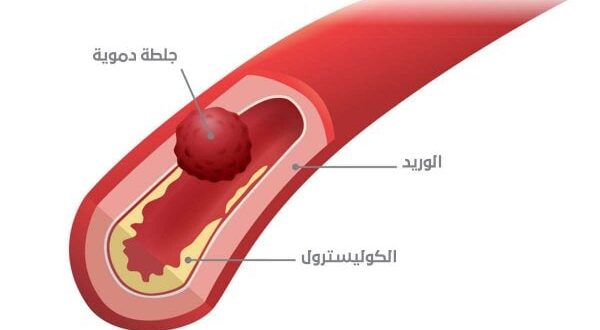 اعراض الجلطة .. احذر من هذه العلامات!